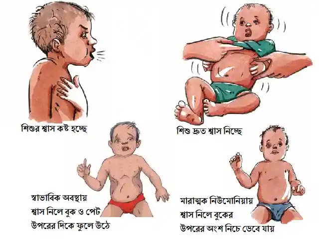 শিশুর নিউমোনিয়ার লক্ষণ